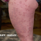 Image for article titled Dr. Pimple Popper Treats Someone With a Tennis Ball-Sized Lump in His Neck